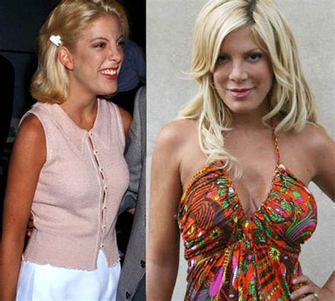 Tori Spelling Before And After Plastic Surgery Celebrity Plastic