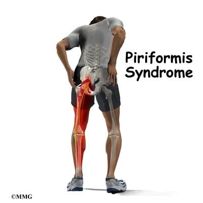 Piriformis Syndrome Physio Pooja