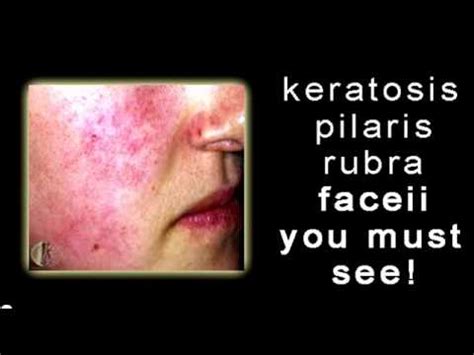Keratosis pilaris, often referred to as kp by beauty aficionados and derms, is a common skin concern that appears as a bumpy chicken skin texture on upper arms, legs, and even faces, caused by excess keratin plugging hair follicles. Keratosis Pilaris Rubra Faceii YOU MUST SEE! - YouTube