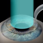 All About Lasik Laser Eye Surgery In Tampa Bay