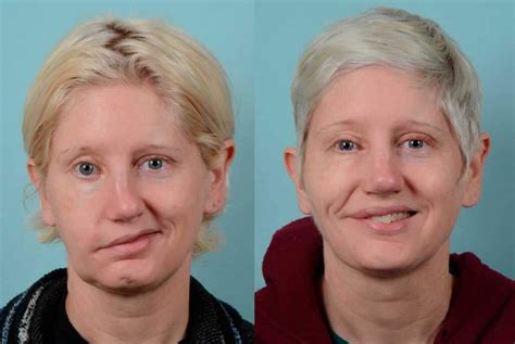 facial nerve center johns hopkins facial plastic and reconstructive surgery
