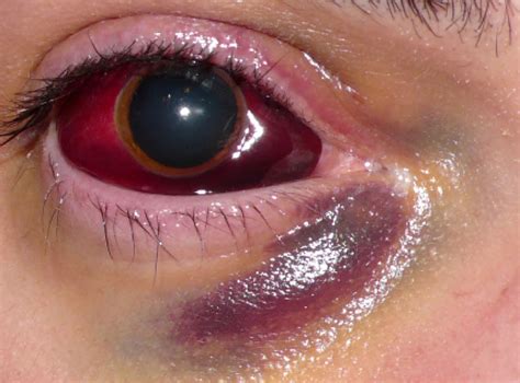 This Massive Subconjunctival Hemorrhage Accompanied Acute Intralesional