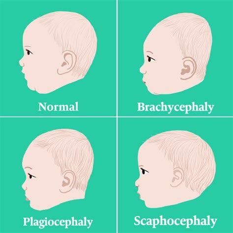 Understanding Flat Head Syndrome Positional Plagiocephaly Dixon Verse