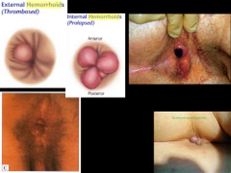 Internal hemorrhoids do not have cutaneous innervation and can therefore be destroyed without anesthetic, and the treatment may be surgical or nonsurgical. Physical Diagnosis Visual Exam Foreign Language Flashcards ...