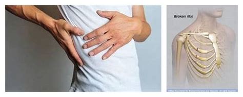Cracked Ribs While Coughing - Treatment and Symptoms ...