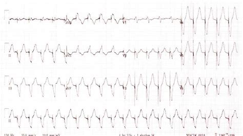 Pacemaker Syndrome