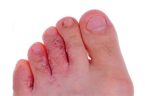 Athlete S Foot Symptoms Treatment And Causes Myhealthcare Clinic