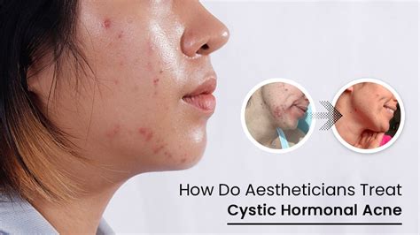 How Do Aestheticians Treat Cystic Hormonal Acne