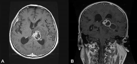 A Case Of Nocardia Farcinica Brain Abscess In The Patient Receiving