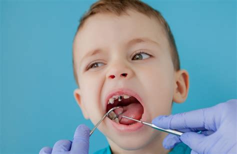 Pediatric Dentistry Babymilk Teeth Suir Clinic Waterford