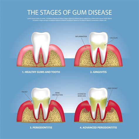 Human Teeth Stages Of Gum Disease Vector Illustration 2441651 Vector