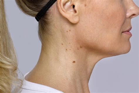 If You Have Bumps On Your Neck Heres What It Could Mean Readers Digest