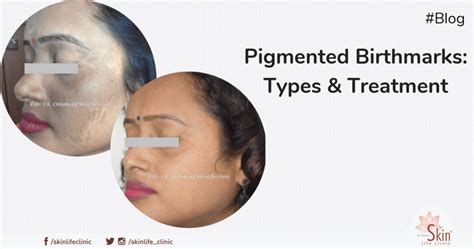 Pigmented Birthmarks Their Types And Treatments