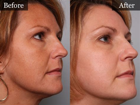 Microdermabrasion And Chemical Peels The Vein Center
