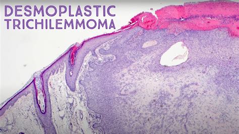 Desmoplastic Trichilemmoma Dermpath In 5 Minutes Dermatology