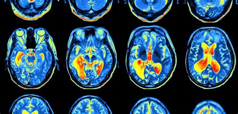 In Alzheimer S Maintaining Active Brain May Slow Cognitive Decline