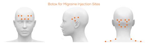 Botox For Migraine Headache In Bali Cocoon Medical Spa
