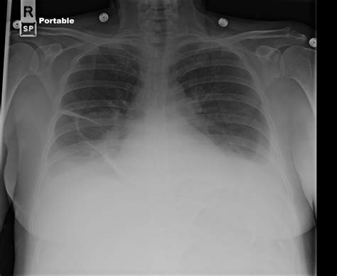 Pulmonary Embolism In Hospitalized Patients