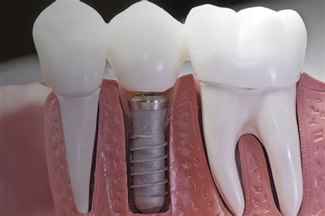 How Long Do Dental Implants Last Dental Implant Lifespan Aria Dental