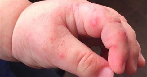 Mom Finds Blisters On Babys Hand Shes Now Warning All Parents About
