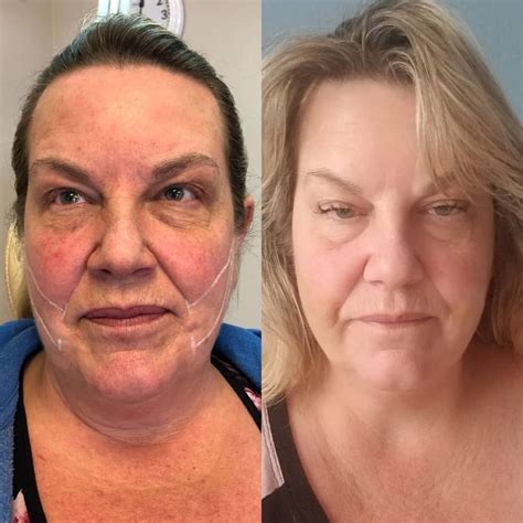 Before And After 😍 Non Surgical Mid Face Thread Lift 💉 For A Lifted