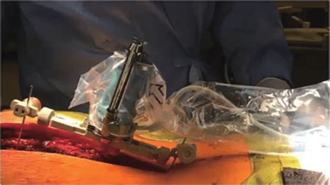 Intraoperative Image Depicting Patient In Prone Position Following