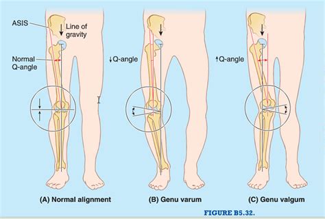 Afbeeldingsresultaat Voor Q Angle Knee Knee Joint Kinesiology