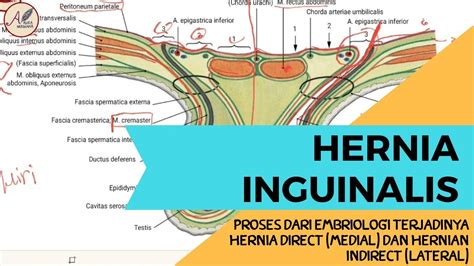 Hernia Inguinal Hernia Direct Medial Dan Hernia Indirect Lateral