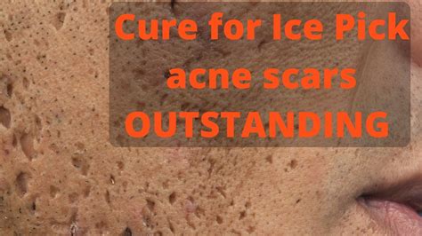 A range of surgical procedures can remove a scar, improve its appearance or transplant skin from another area (skin graft). How to treat ice pick acne scars - YouTube
