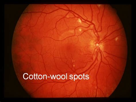 Cotton Wool Spots Of Early Hiv Retinopathy Young Patients With These