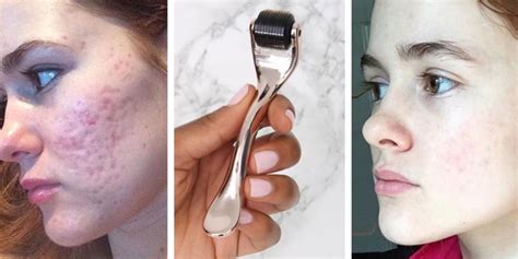 While retinol works well to minimise marks left behind by acne, dermatologists argue that much deeper scars are unlikely to respond. Dermarolling Before and After Pics - Dermarolling for ...