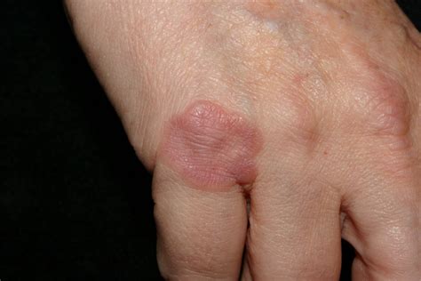 Granuloma Annulare Causes Rash Treatment