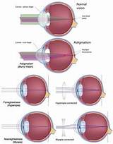 Photos of Intralase Lasik Eye Surgery