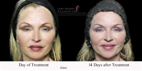 Skincare Treatment Results Jeffrey Carls Md Pc