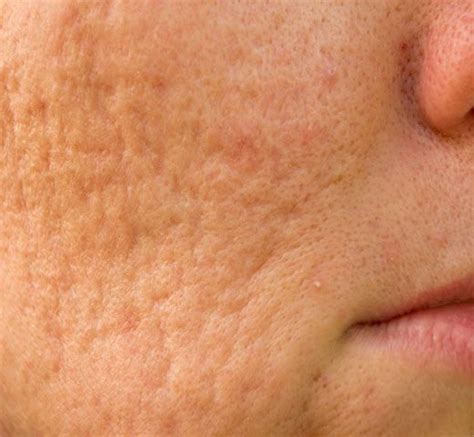 Best Acne Scars Treatment In Charlotte Nc Dlvsc