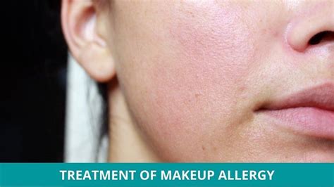 Allergic Reaction Makeup Rash Tutorial Pics