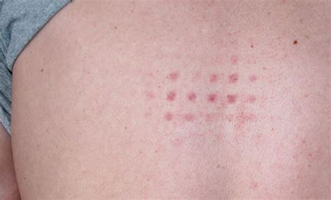 What Is Up With This Grid Rash I Can Only Find Information About It