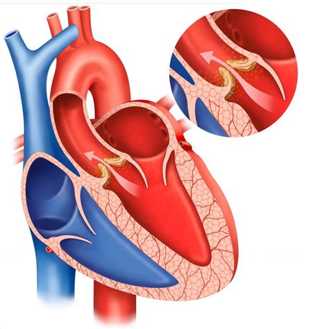 Aortic Valve Stenosis Causes Symptoms Diagnosis And T