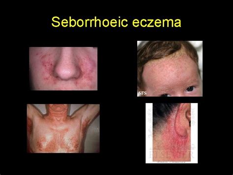 Atopic Eczema Sharon Wong Suzy Tinker Classification Endogenous