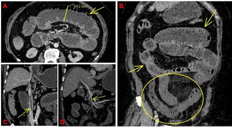 Images From Portal Venous Phase Ct Scan Of The Abdomen A Axial Ct