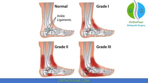 Lateral Ankle Sprain • Easy Explained Orthofixar 2022