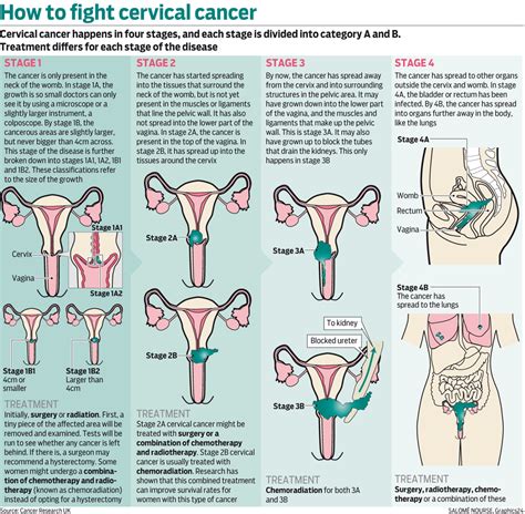 Different Stages Of Cervical Cancer And How To Treat It Graphics