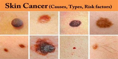 Skin Cancer Causes Types Risk Factors Assignment Point