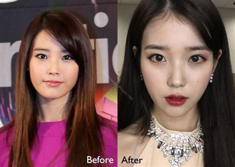 Kpop Korean Plastic Surgery Before And After Kpop Lovin