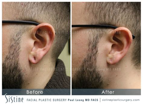 Earlobe Repair Before And After 04 Sistine Facial Plastic Surgery