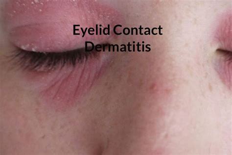 What Triggers Irritant Eyelid Contact Dermatitis Soaps And Detergents