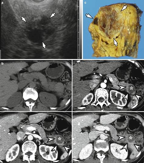 Cystic Tumors Of The Pancreas Radiology Key
