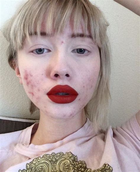 Teenager Shares Her Acne On Social Media To Help Other People