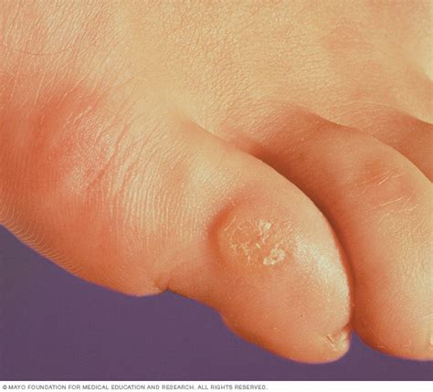 Corns And Calluses Disease Reference Guide