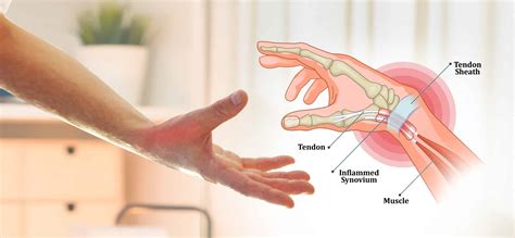 Thumb And Wrist Pain De Quervains Tenosynovitis Solutions My Xxx Hot Girl